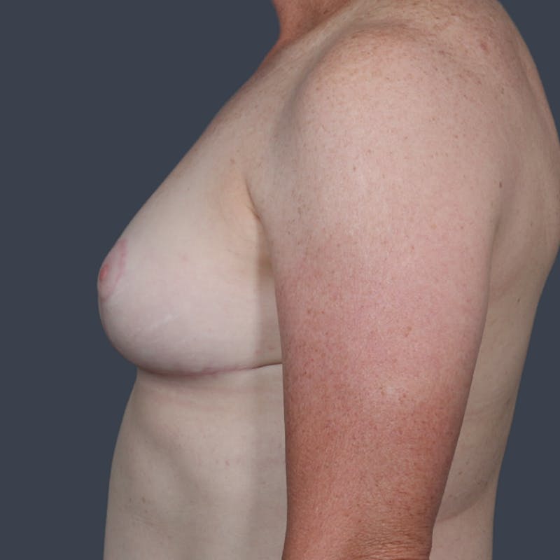 Breast Reduction Before & After Gallery - Patient 362384 - Image 4