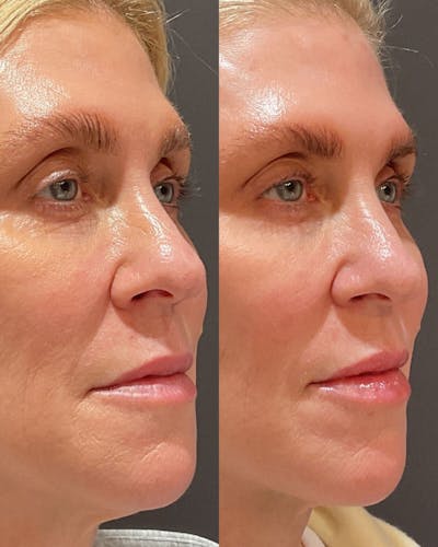 Facial Balancing Before & After Gallery - Patient 369687 - Image 1