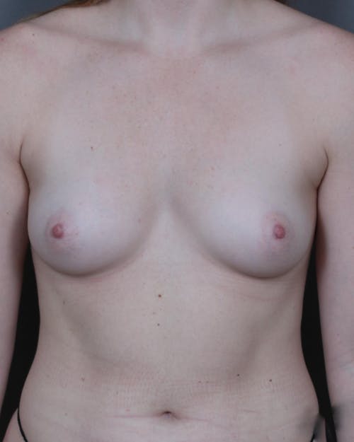 Before procedure image for Breast Augmentation