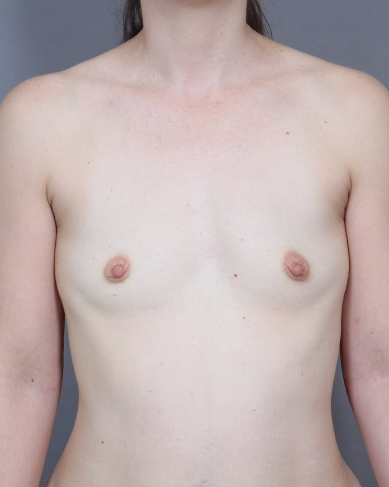 Breast Augmentation  Before & After Gallery - Patient 241567 - Image 1