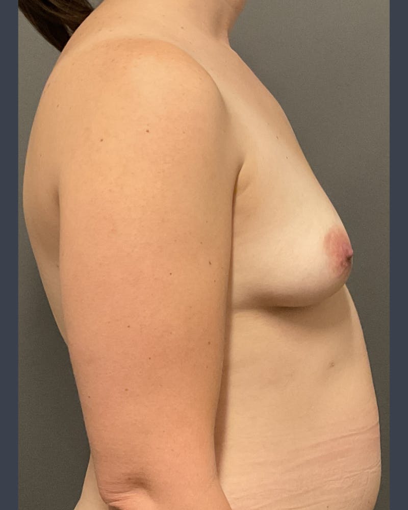 Breast Augmentation  Before & After Gallery - Patient 475997 - Image 5
