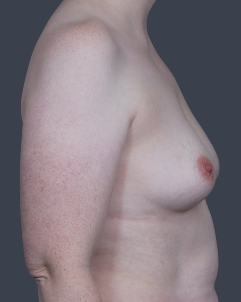 Breast Augmentation  Before & After Gallery - Patient 272234 - Image 3