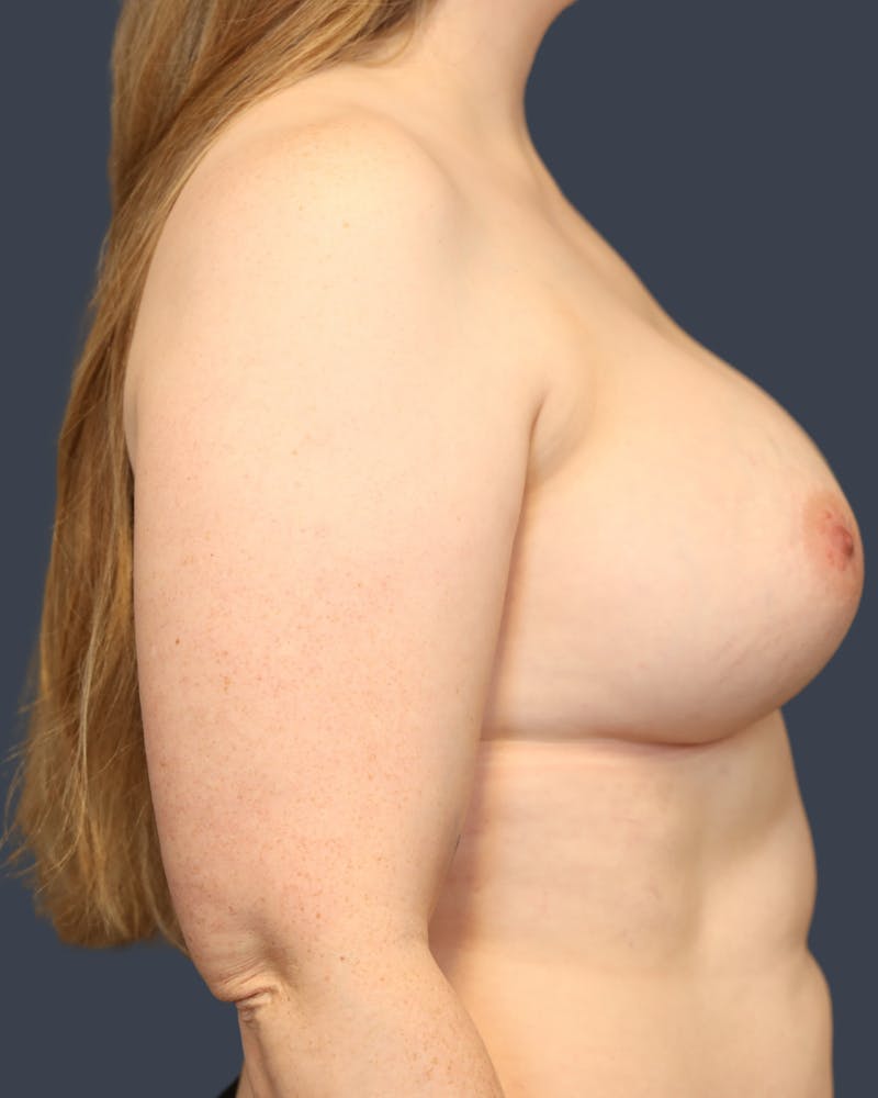 Breast Augmentation  Before & After Gallery - Patient 272234 - Image 4