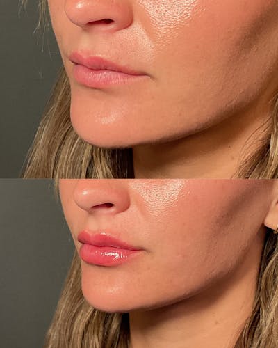 Lip Filler Before & After Gallery - Patient 328144 - Image 1