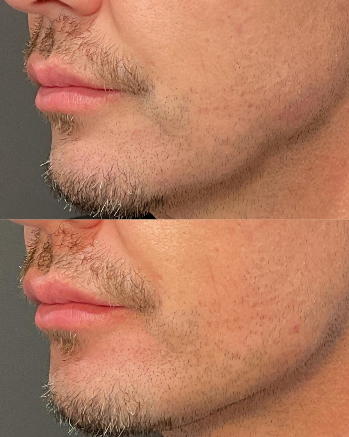 Radiesse Before & After Gallery - Patient 392652 - Image 1