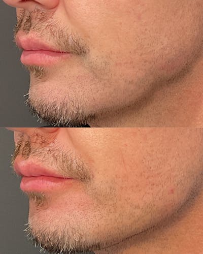 Radiesse Before & After Gallery - Patient 392652 - Image 1