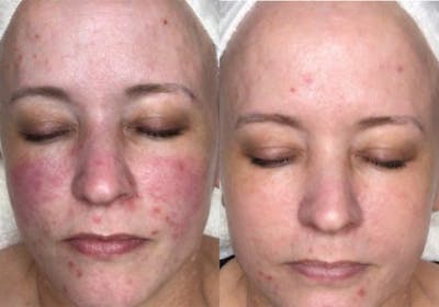 Aerolase Before & After Gallery - Patient 322211 - Image 1