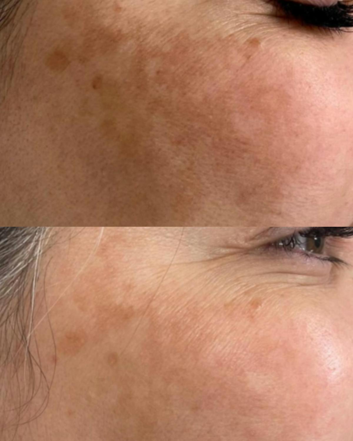 Aerolase Before & After Gallery - Patient 396164 - Image 1