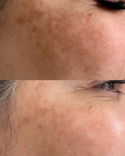 Aerolase Before & After Gallery - Patient 396164 - Image 1