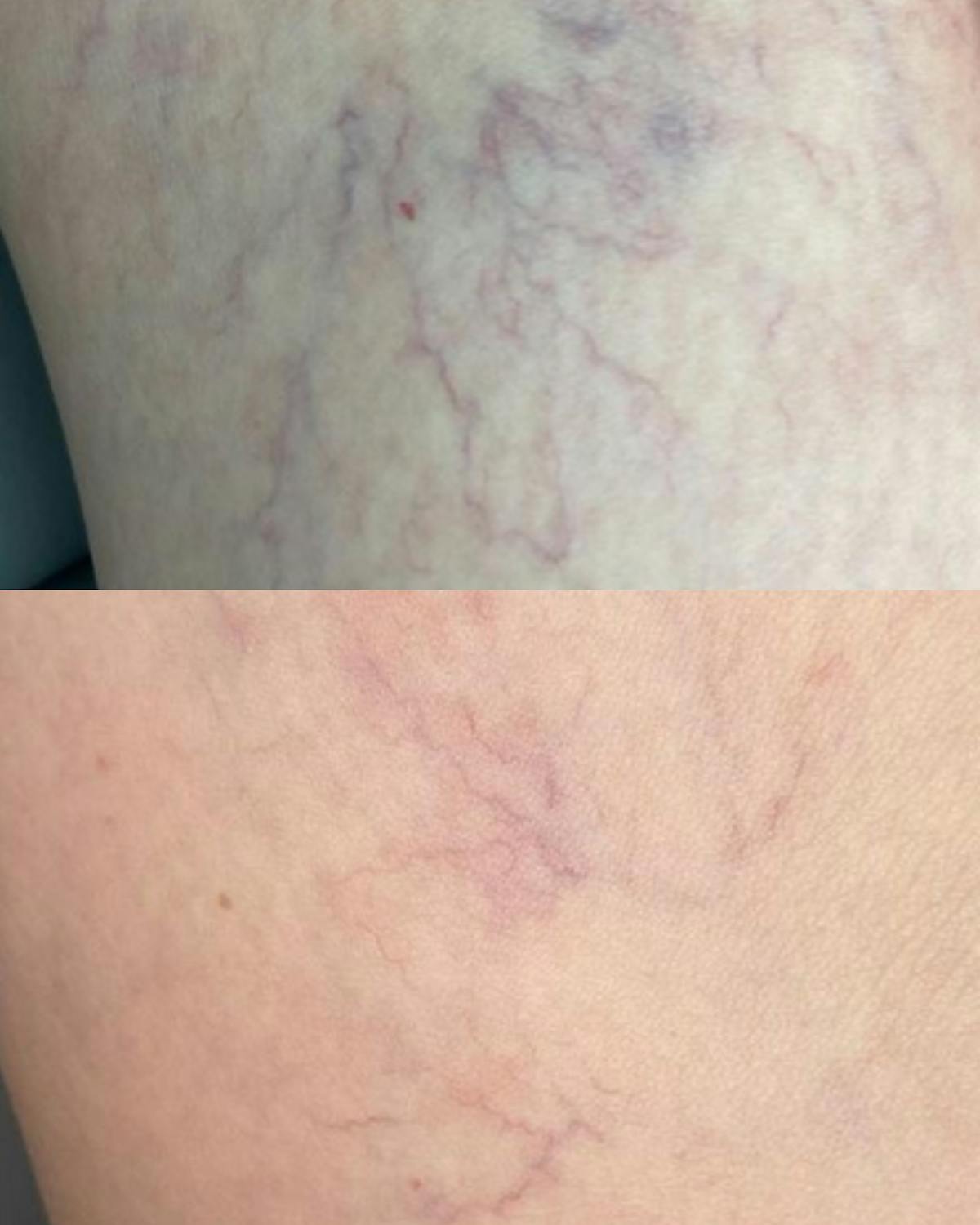 Aerolase Before & After Gallery - Patient 375731 - Image 1