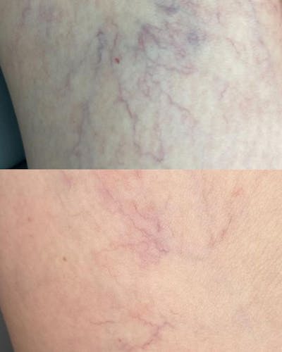 Aerolase Before & After Gallery - Patient 375731 - Image 1