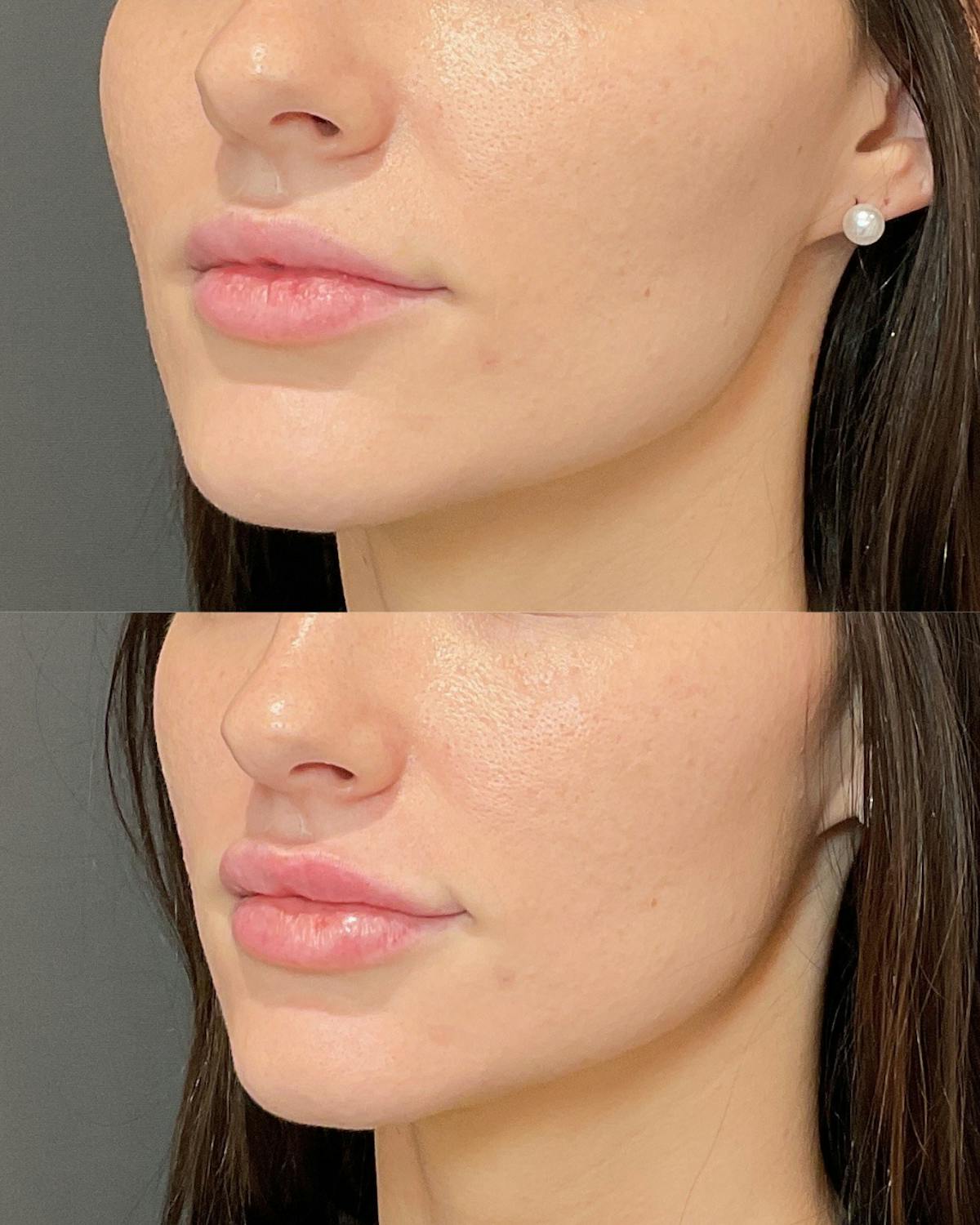 Lip Filler Before & After Gallery - Patient 327992 - Image 1