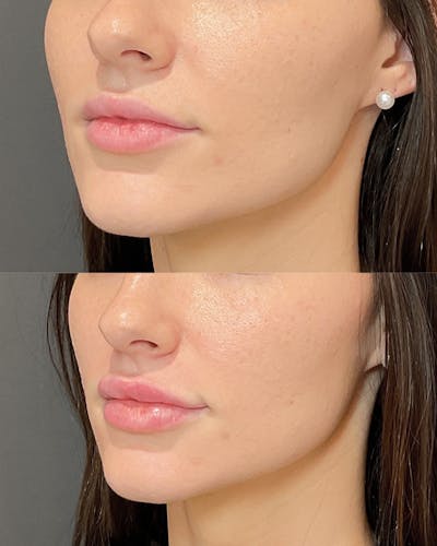 Lip Filler Before & After Gallery - Patient 327992 - Image 1