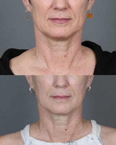 Filler Before & After Gallery - Patient 386349 - Image 1