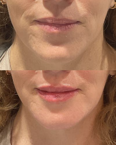 Lip Filler Before & After Gallery - Patient 958192 - Image 1