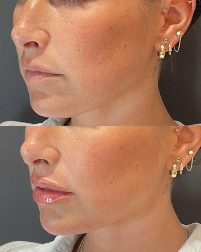 Lip Filler Before & After Gallery - Patient 191353 - Image 1