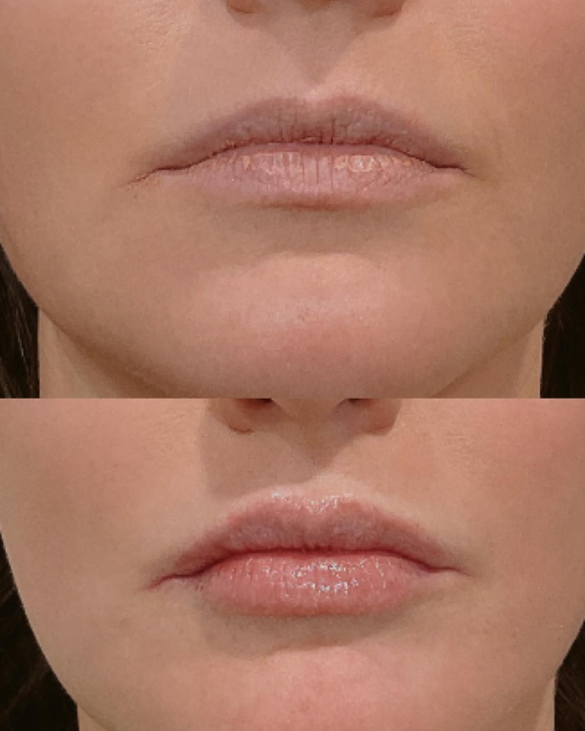 Lip Filler Before & After Gallery - Patient 779285 - Image 1
