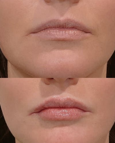 Lip Filler Before & After Gallery - Patient 779285 - Image 1