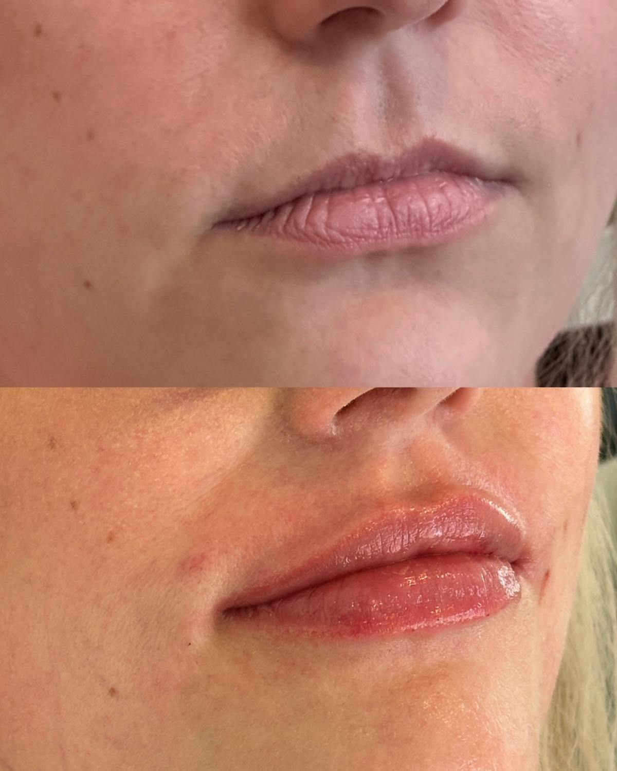 Lip Filler Before & After Gallery - Patient 144567 - Image 1