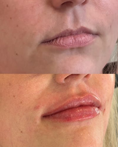 Lip Filler Before & After Gallery - Patient 144567 - Image 1