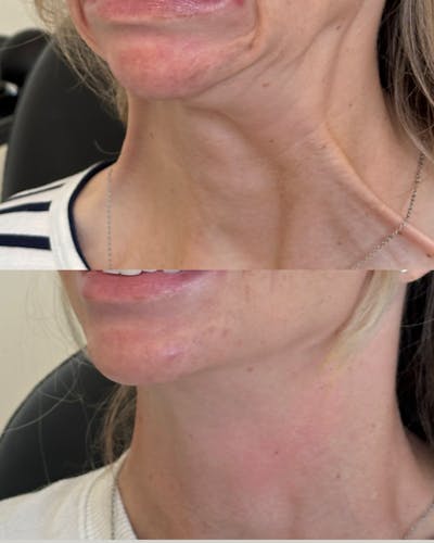 Nefertiti Neck Lift Before & After Gallery - Patient 959517 - Image 1