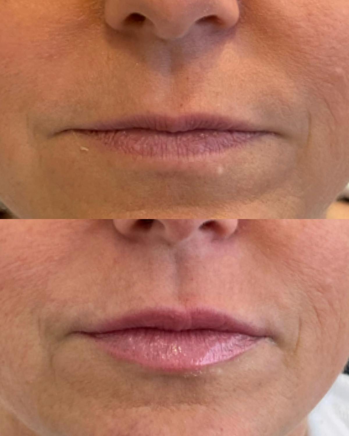 Lip Filler Before & After Gallery - Patient 265698 - Image 1