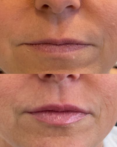 Lip Filler Before & After Gallery - Patient 265698 - Image 1