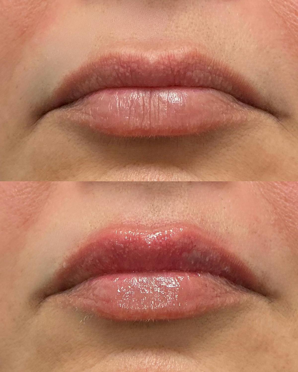 Lip Filler Before & After Gallery - Patient 172119 - Image 1