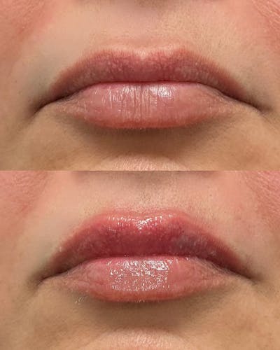 Lip Filler Before & After Gallery - Patient 172119 - Image 1