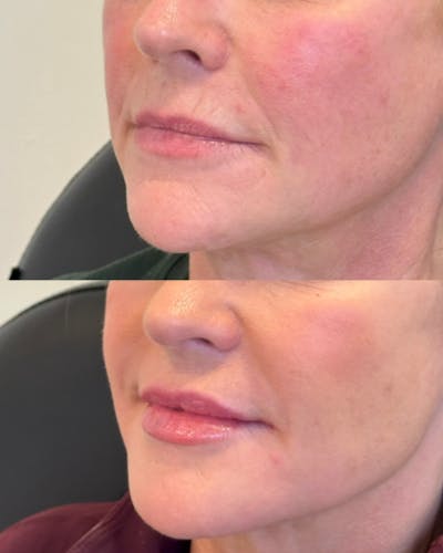 Lip Filler Before & After Gallery - Patient 437085 - Image 1