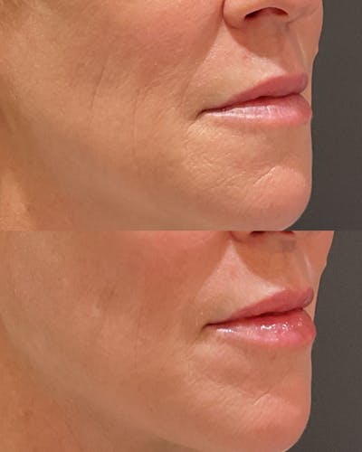 Lip Filler Before & After Gallery - Patient 298279 - Image 1
