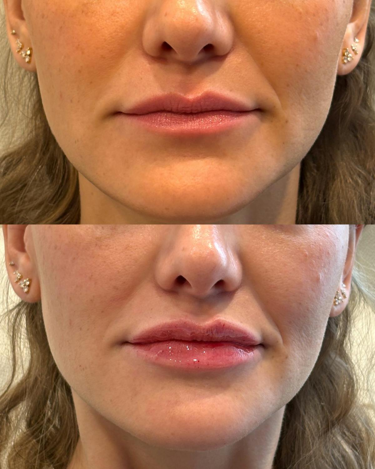 Lip Filler Before & After Gallery - Patient 492317 - Image 1