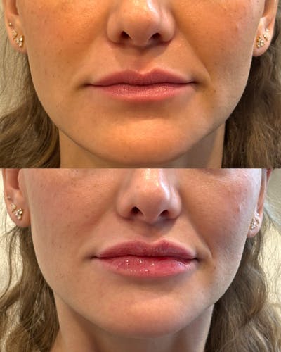 Lip Filler Before & After Gallery - Patient 492317 - Image 1