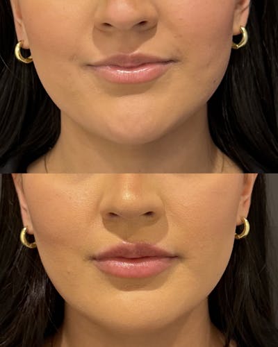 Lip Filler Before & After Gallery - Patient 127732 - Image 1