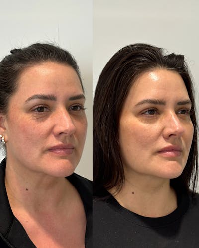 Facial Balancing Before & After Gallery - Patient 516822 - Image 1