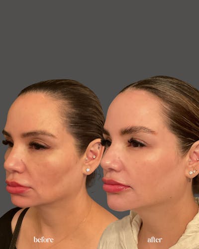 Facial Balancing Before & After Gallery - Patient 403764 - Image 1