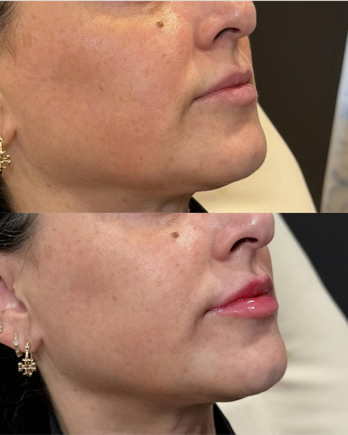 Lip Filler Before & After Gallery - Patient 327664 - Image 1