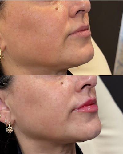 Lip Filler Before & After Gallery - Patient 327664 - Image 1