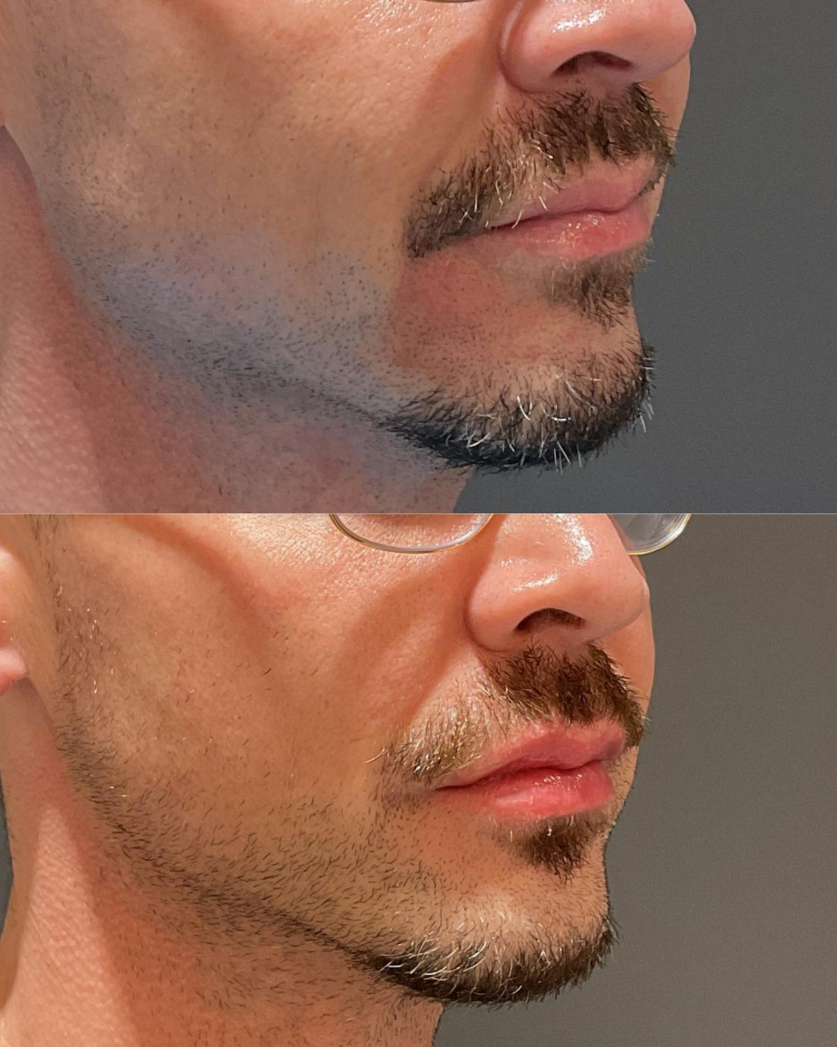 Lip Filler Before & After Gallery - Patient 598206 - Image 2