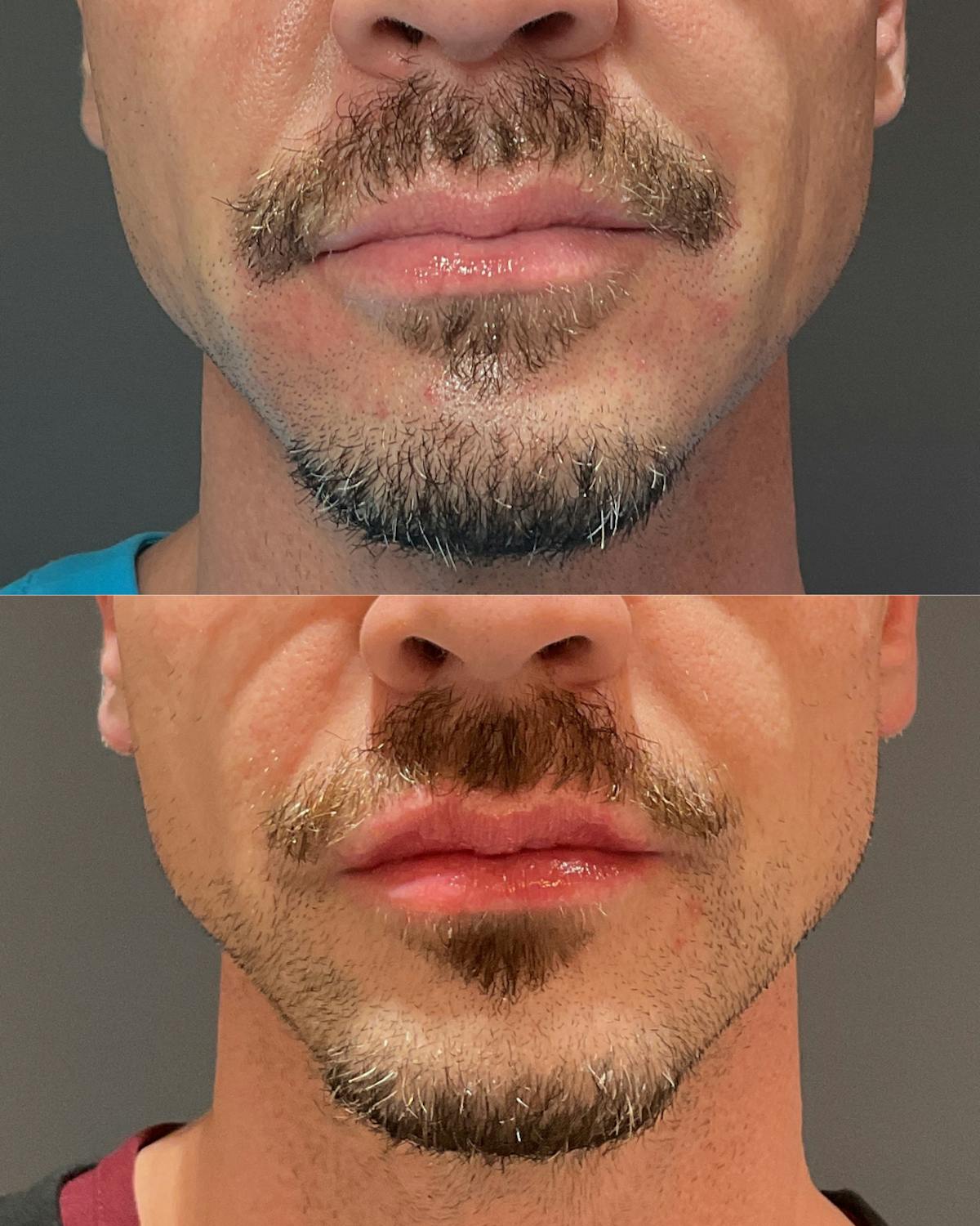 Lip Filler Before & After Gallery - Patient 598206 - Image 1
