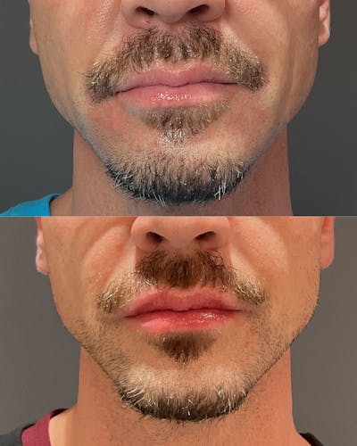 Lip Filler Before & After Gallery - Patient 598206 - Image 1