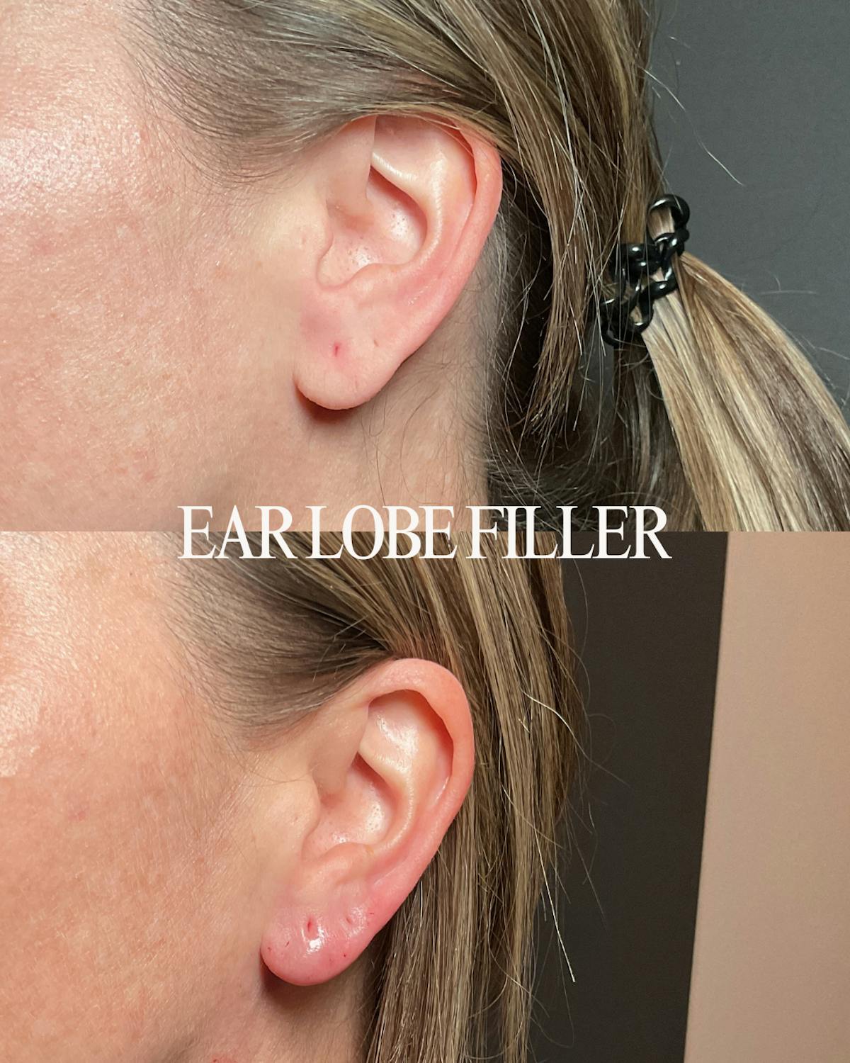Filler Before & After Gallery - Patient 595666 - Image 1