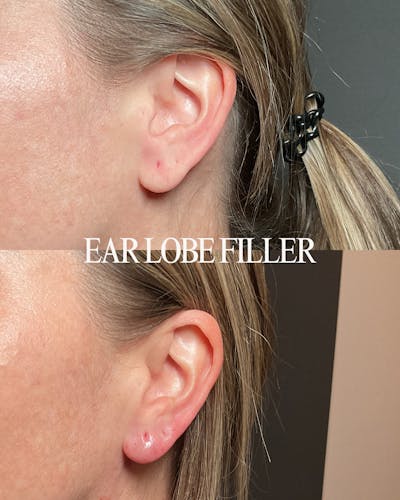 Filler Before & After Gallery - Patient 595666 - Image 1