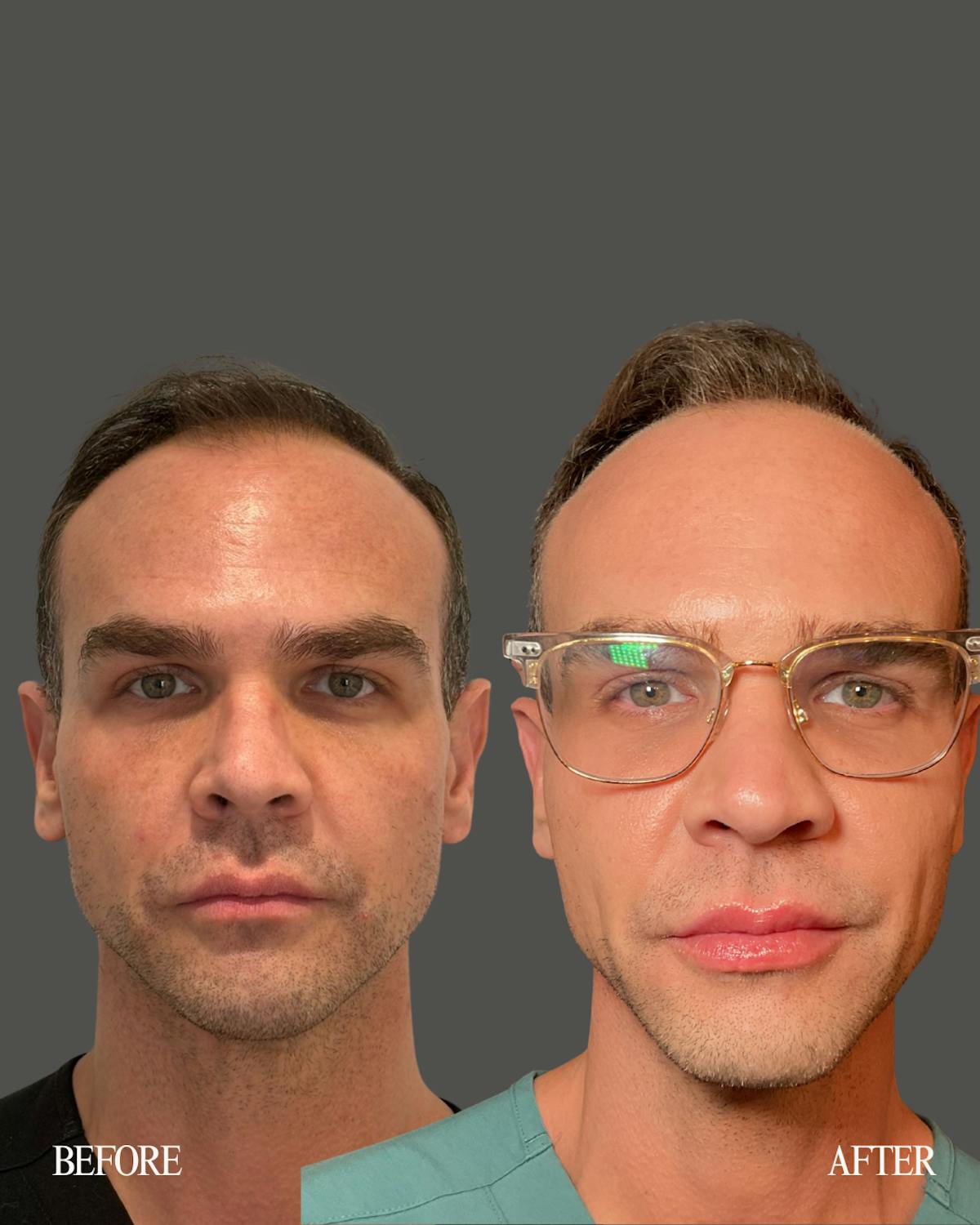 Facial Balancing Before & After Gallery - Patient 923308 - Image 1