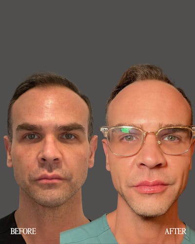 Facial Balancing Before & After Gallery - Patient 923308 - Image 1