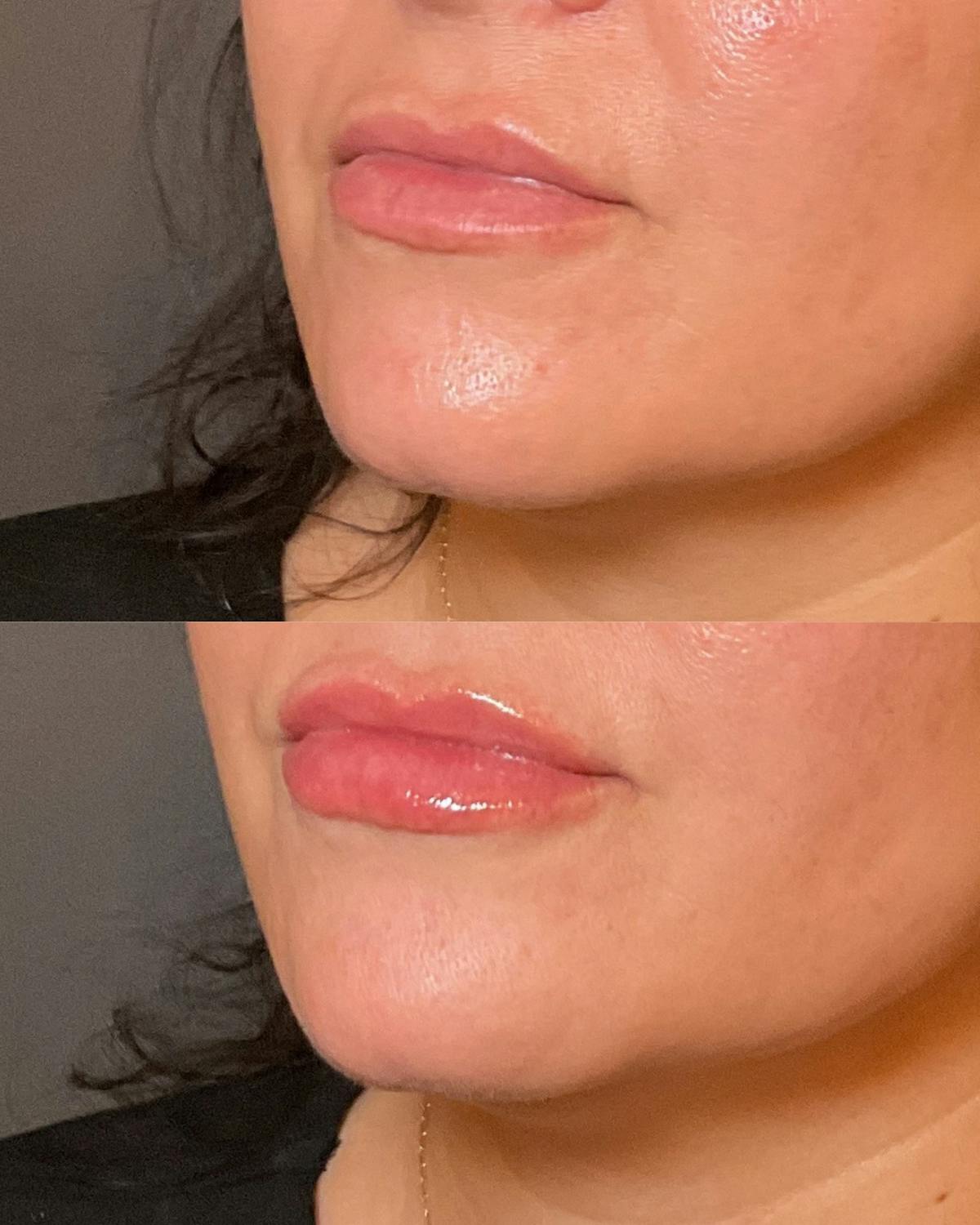Lip Filler Before & After Gallery - Patient 676263 - Image 1