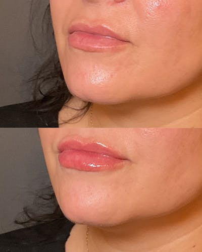 Lip Filler Before & After Gallery - Patient 676263 - Image 1