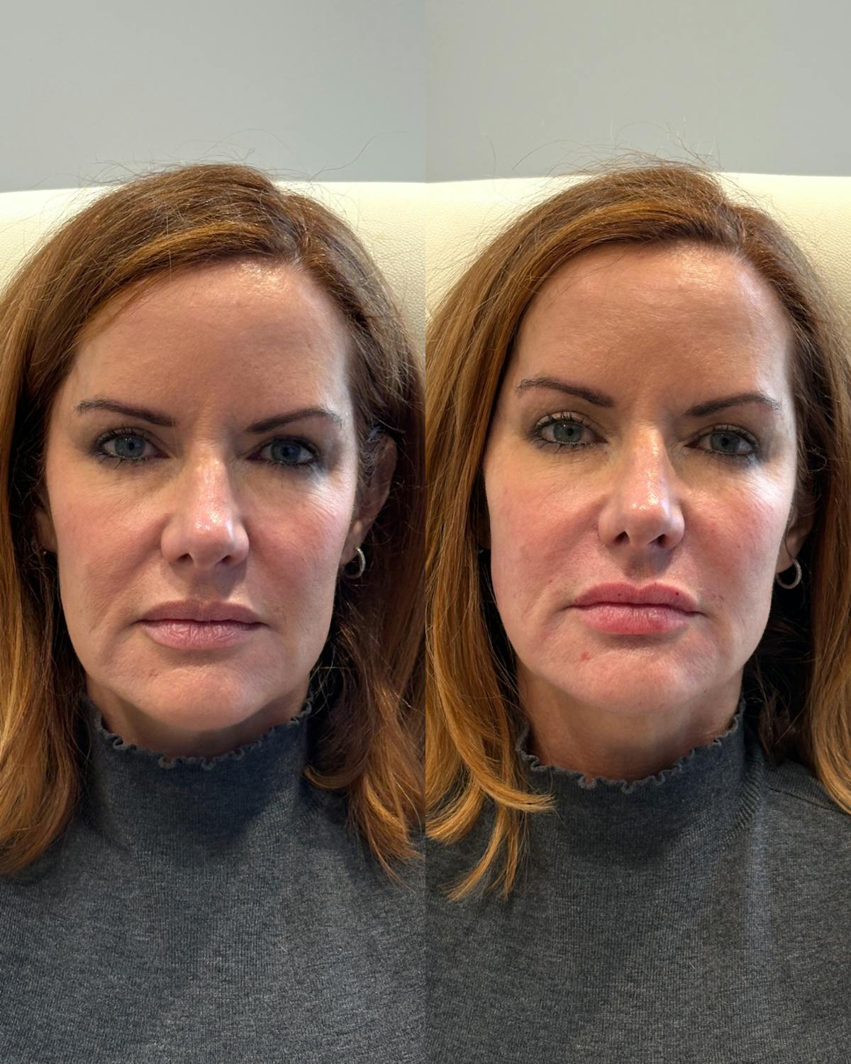 Facial Balancing Before & After Gallery - Patient 140897 - Image 1