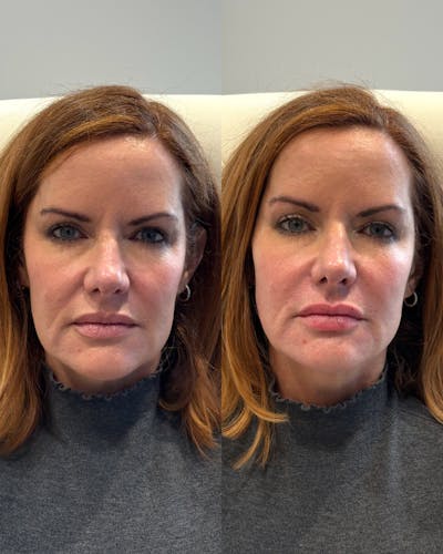 Facial Balancing Before & After Gallery - Patient 140897 - Image 1
