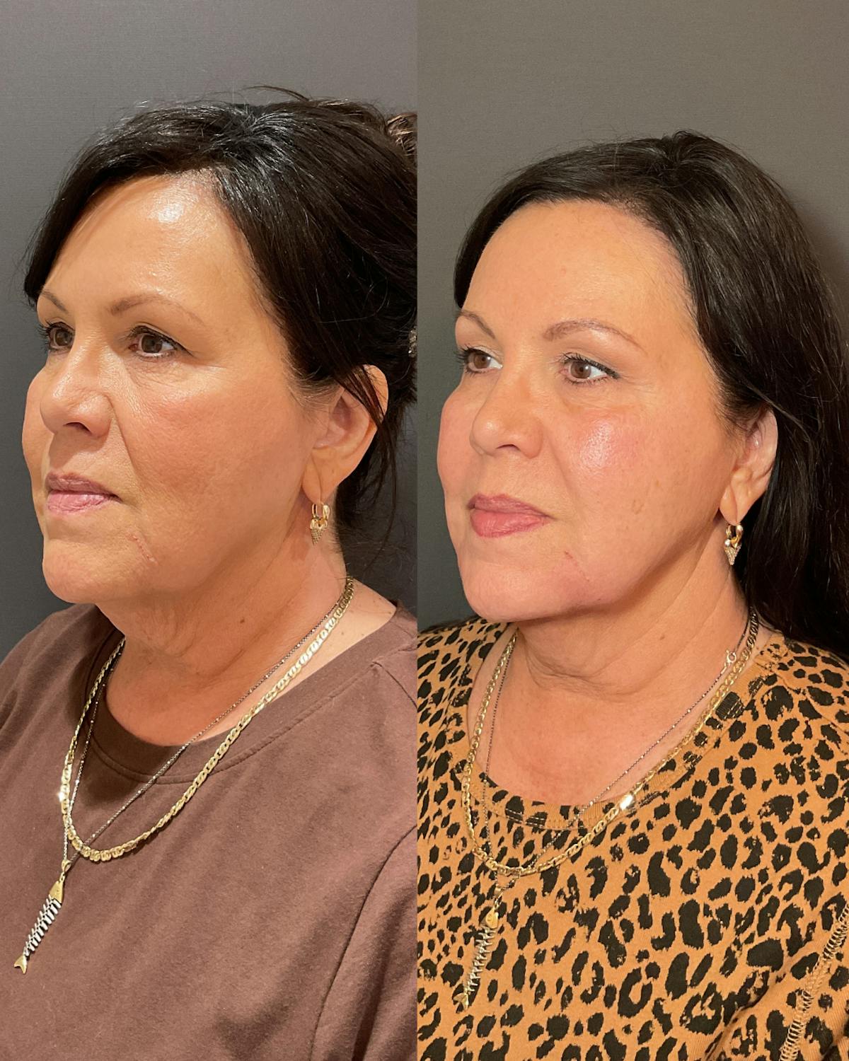 Facial Balancing Before & After Gallery - Patient 678734 - Image 1